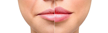 Augmentation temporaire des lips par injection d'Hyaluronic acid