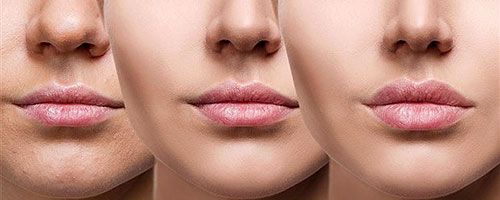 Esthetic medicine Juventas - Fillers, injections : Hyaluronic acid, dark circles, wrinkles, lips, non-surgical treatments, BOTOX®, rhinoplastie...