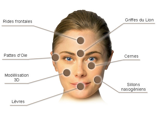 Zones de Esthetic treatments : BOTOX®, wrinkles, pattes d'oies...