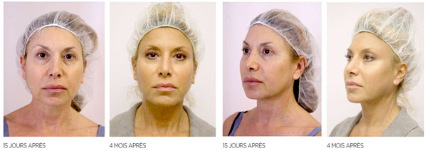 Médecine esthétique Juventas - Comblement, injections : acide hyaluronique, cernes, rides, lèvres, soins non chirurgicaux, BOTOX®, rhinoplastie...