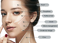 HIFU, lifting thérapie par ultrasons
