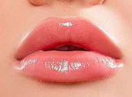 Russian Lips, repulpage des lèvres grâce à l'acide hyaluronique